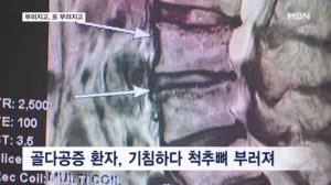 기침 한 번에 척추뼈 6개 뚝…'도미노 골절' 부르는 골다공증 주의보