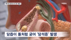 명치 끝을 칼로 찌르는 고통…위가 아니라 쓸개가 문제였다