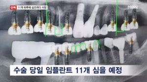 [단독] 임플란트 11개 하루에 심으려다 사망…국과수 "마취제 독성 때문"