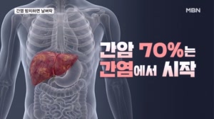 간암 70%는 간염에서 시작…간염 방치했다 날벼락