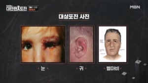대상포진 바이러스, 뇌도 공격한다