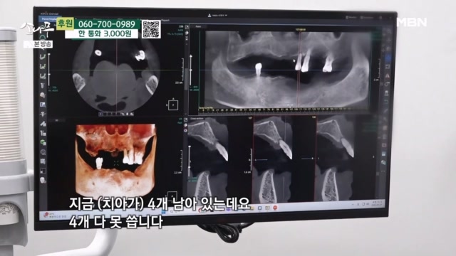 남은 치아마저 모두 발치한 아빠