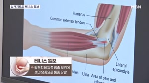 인천 테니스 엘보 하루 두세 번 아프면 테니스 엘보 의심